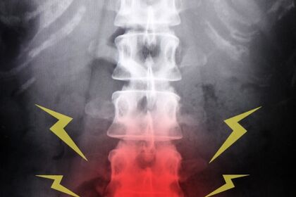 腰のレントゲン画像